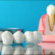 Dental Bridges