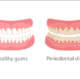 Gum Disease