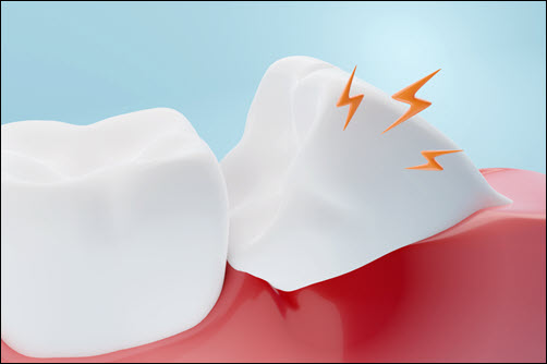 Impacted Teeth