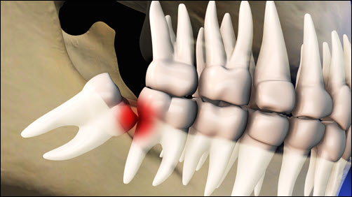 Impacted Teeth