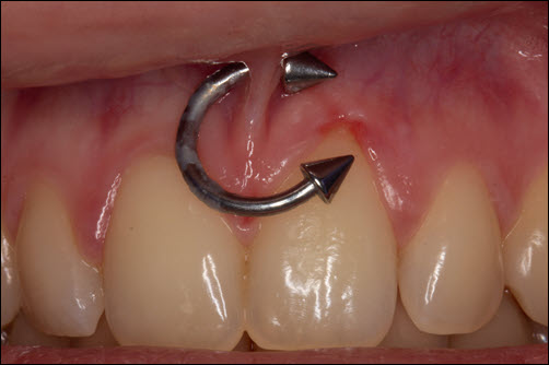 Oral Piercings